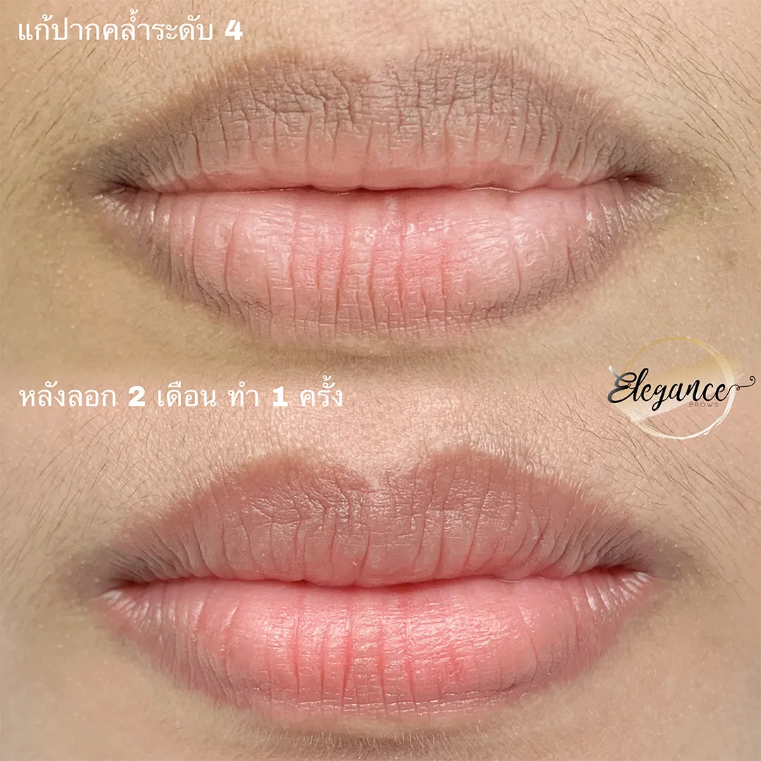 ฝังสีปาก (3)_3